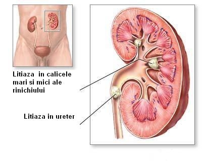 Adenomul de prostata, litiaza renala